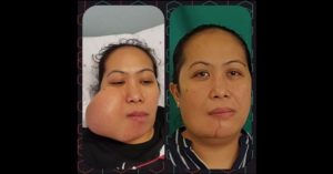 Pinay Domestic Worker Undergoes Breakthrough Surgery in Bahrain